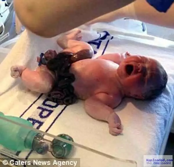 Omg! Miracle Baby Born With Intestines And Bladder Outside His Body (Photos)